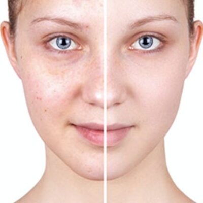 Hyperpigmentation