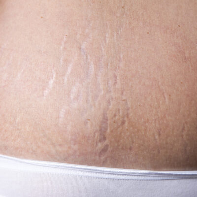 Stretch Marks